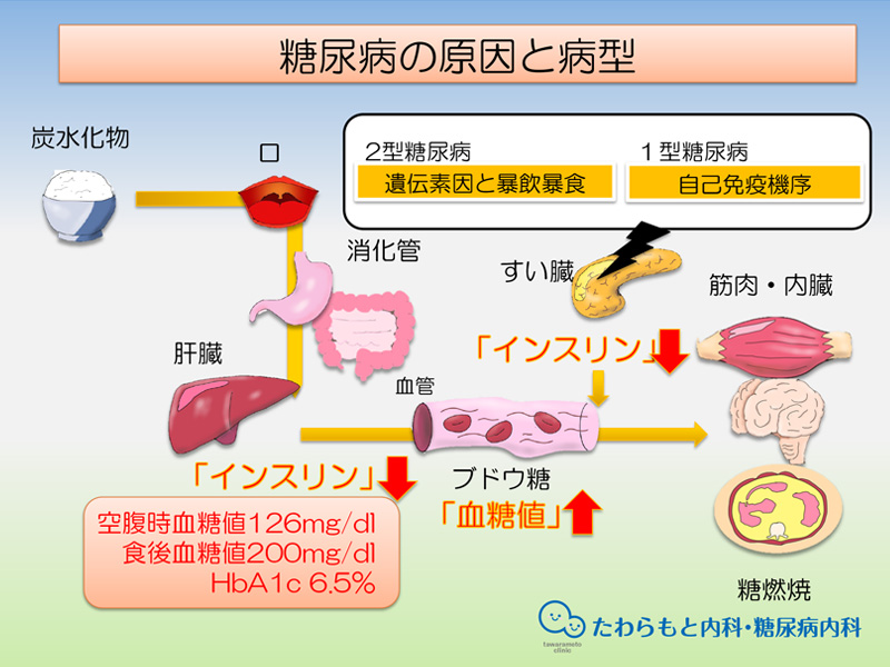 持続血糖モニター